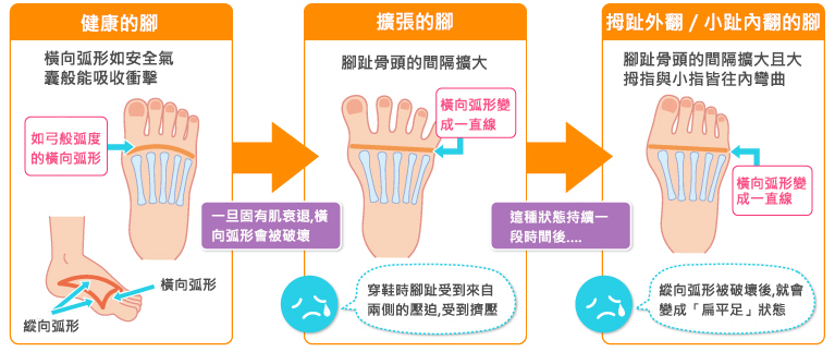足部のむくみ、通称“クリームパン足”の原因になります。